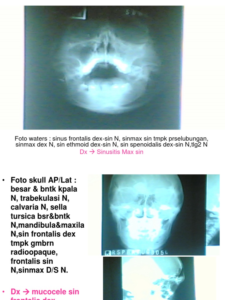 Pdf Jurnal Sinusitis