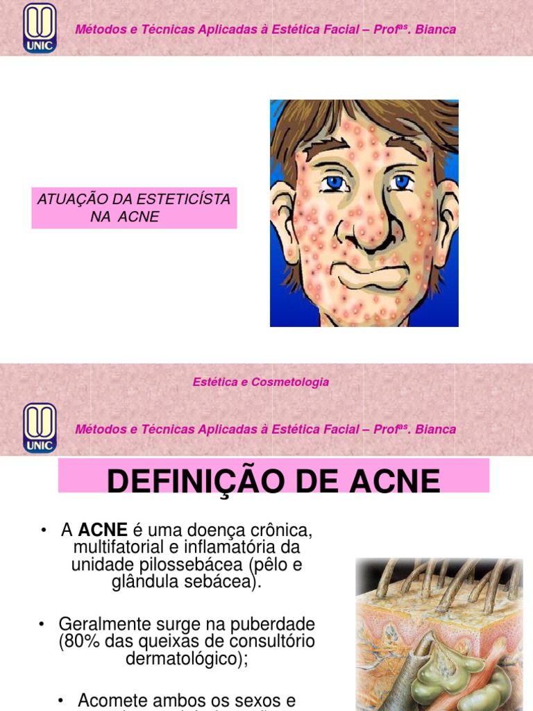 Os principais m todos e t cnicas de tratamento da acne vulgar juvenil