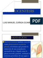 Toracocentesis