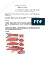 Jurding Vasculitis