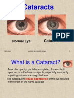 D-L Cataract Information JVC - PPS