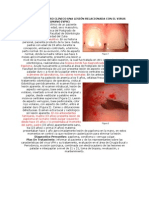 Reporte de Un Caso Clinico Una Lesión Relacionada Con El Virus Papiloma Humano