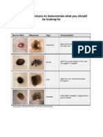 Melanoma - Pictures To Demonstrate What You Should Be Looking For