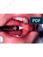 Inferior Alveolar Nerve Block 