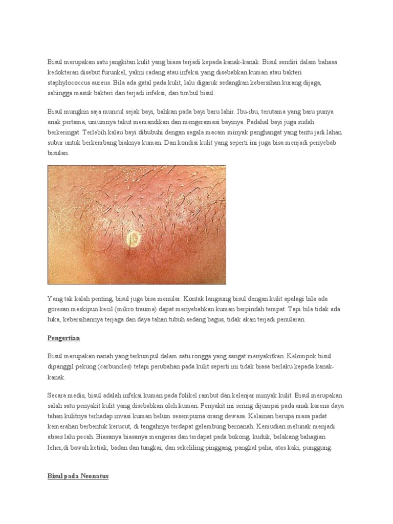 Penyebab Bisul Bisul Di Kulit Kepala Berbagai Sebab Penyebab Bisul Bisul Di Kulit Kepala Berbagai Sebab