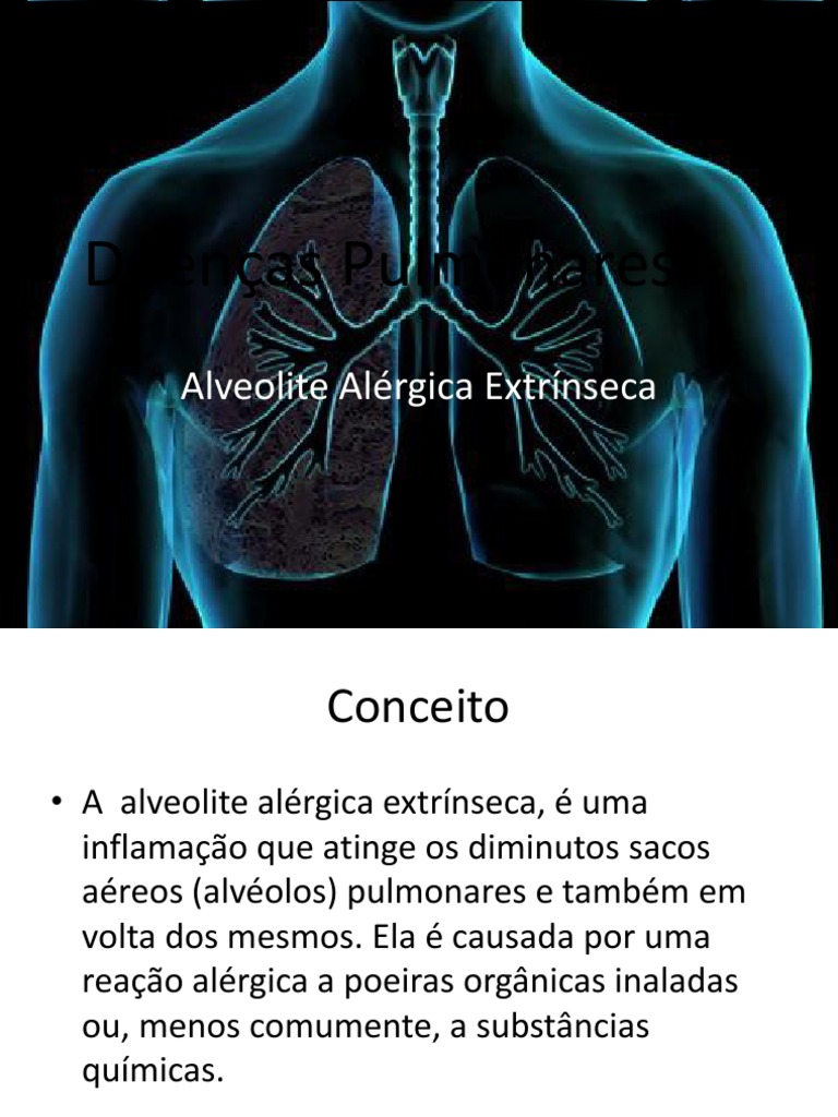 Doenças Pulmonares Alveolite | PDF | Pulmão | Inflamação