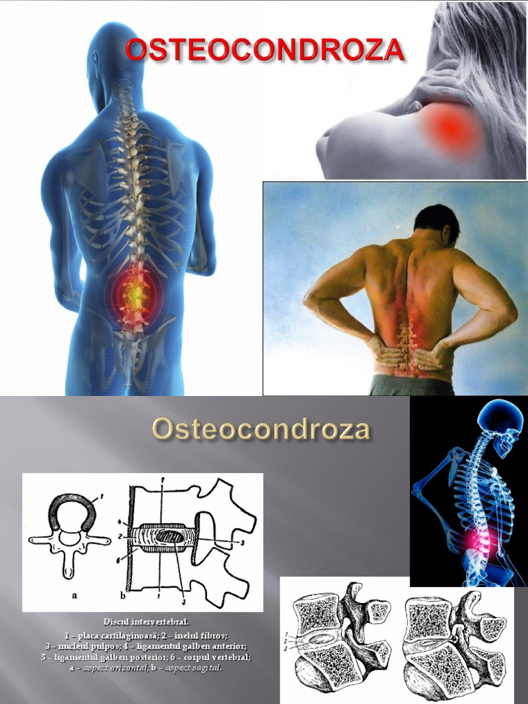 osteochondroza preparatelor coloanei vertebrale cervicotoracice)