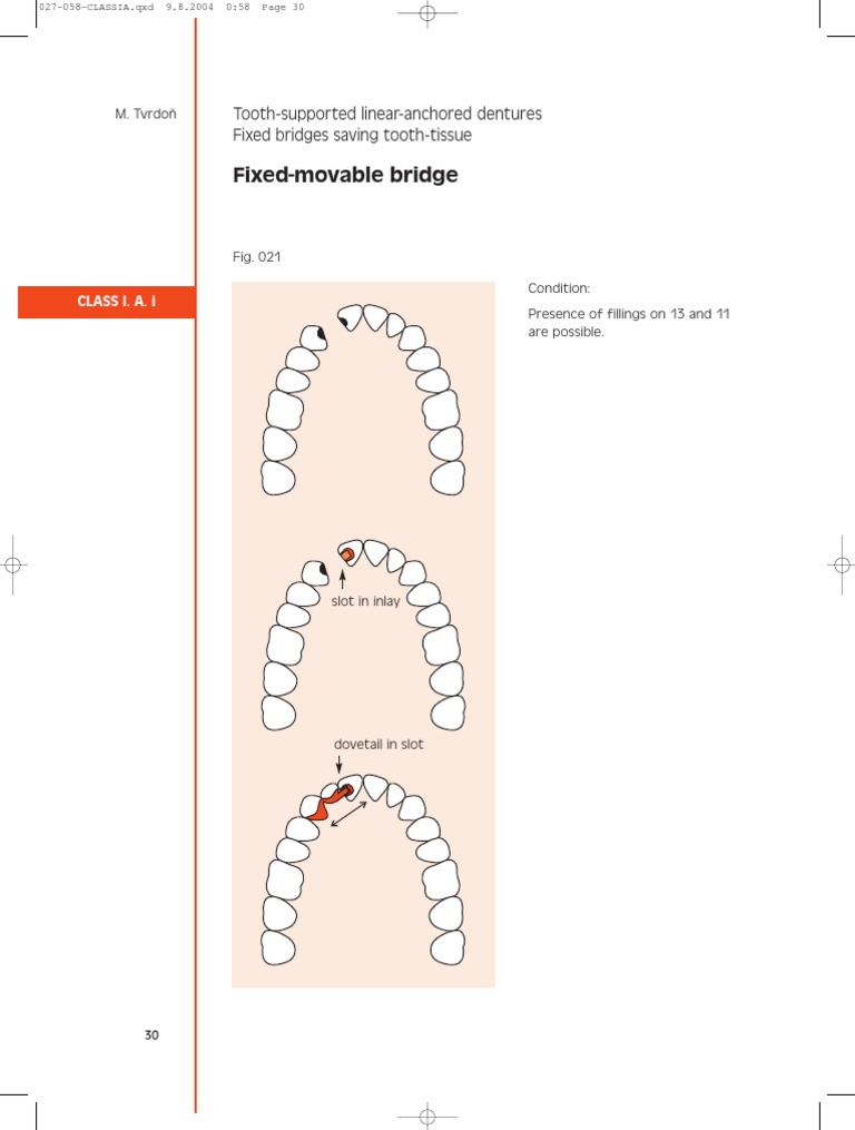 Tooth-Supported Dentures Overview | PDF | Technology & Engineering