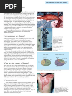 2nd degree burn case study picture