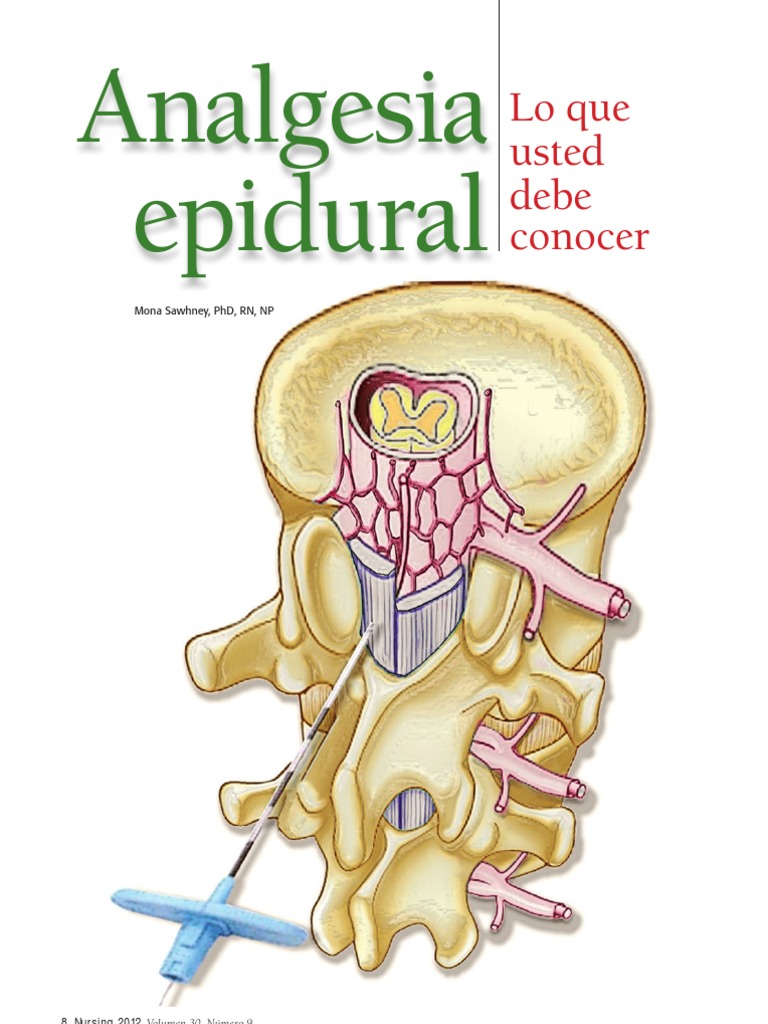 Analgesia Epidural Lo Que Usted Debe Conocer Medicamentos con receta
