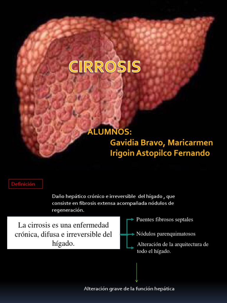Cirro Sis Cirrosis Hepatitis
