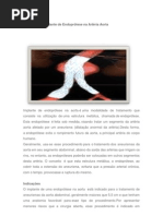 Implante de Endoprótese na Artéria Aorta