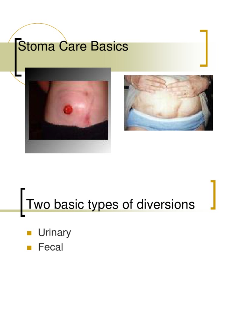 Stoma Care Basics Gastroenterology Digestive System