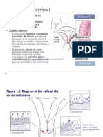 Carcinoma Cervical