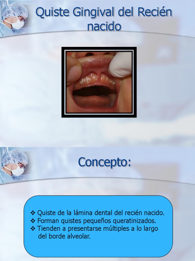 Quiste Gingival del Recién nacido