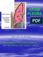 Efusi Pleura Power Point