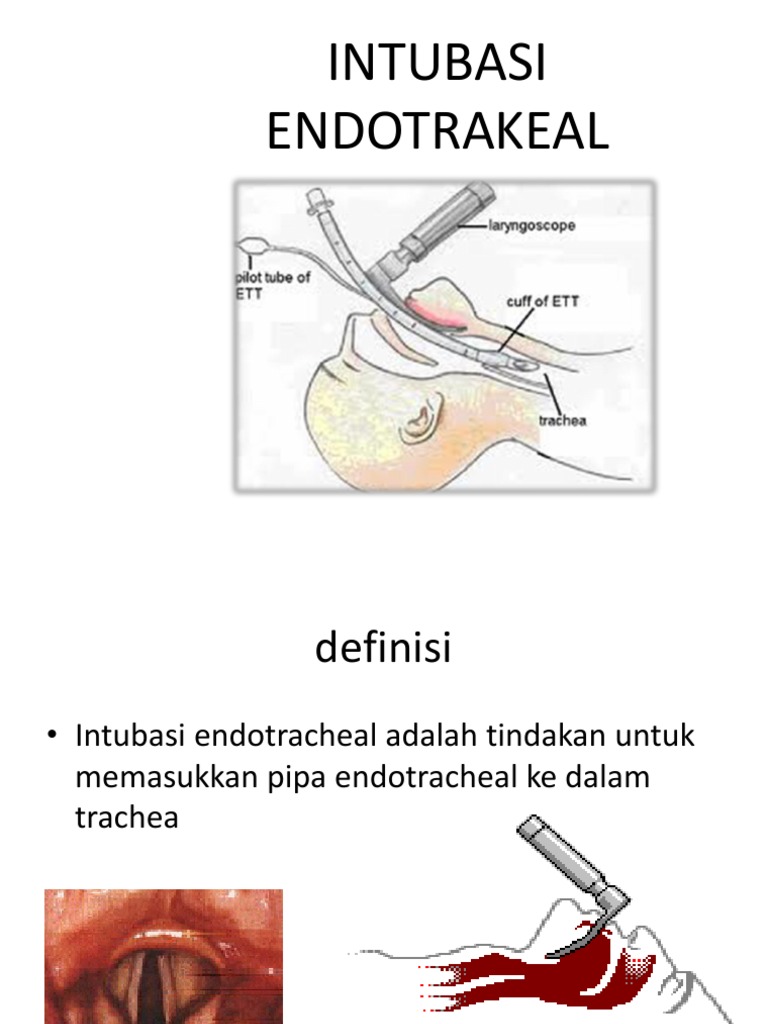  Ett Dan Trakeostomi