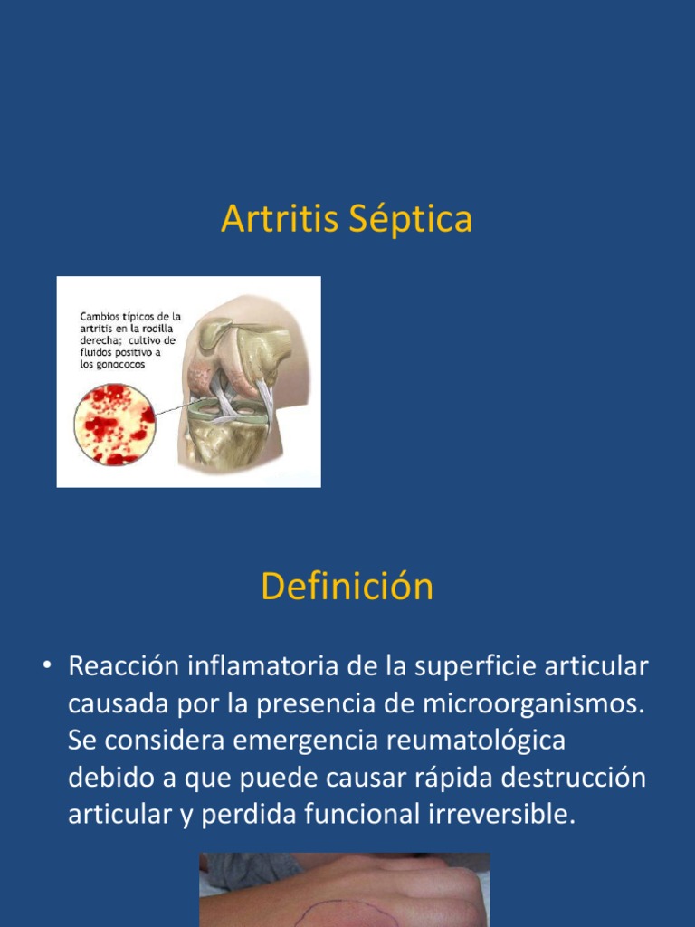 Artritis Séptica Especialidades médicas Medicina clínica