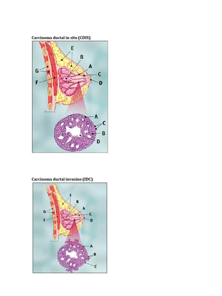 Understanding Carcinoma Ductal In Situ | PDF