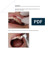 Caso Clínico Duofluorid