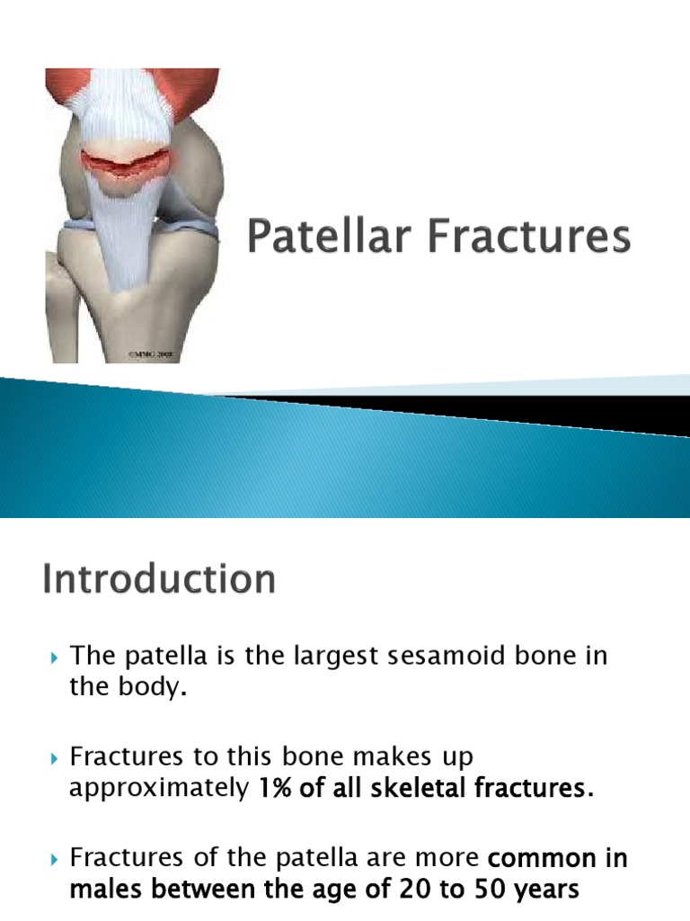 Patellar Fractures Knee Limbs (Anatomy)