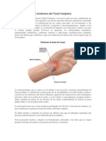 Fisiopatología Del Síndrome Del Túnel Carpiano