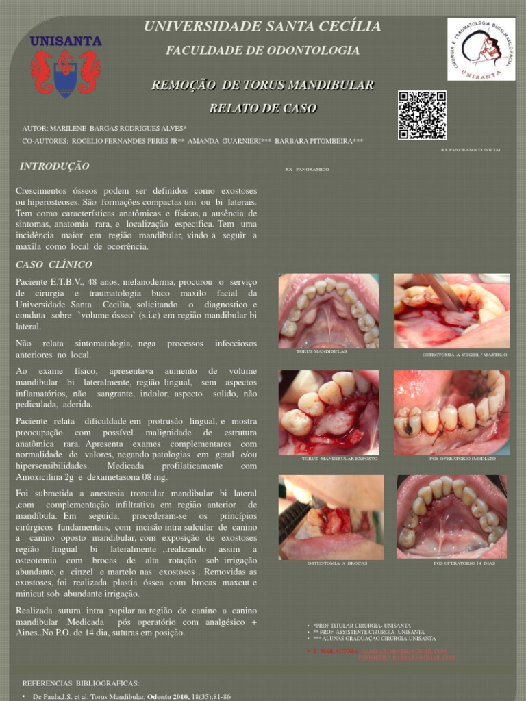 Caso raro de extensa exostose maxilar e mandibular: relato de caso