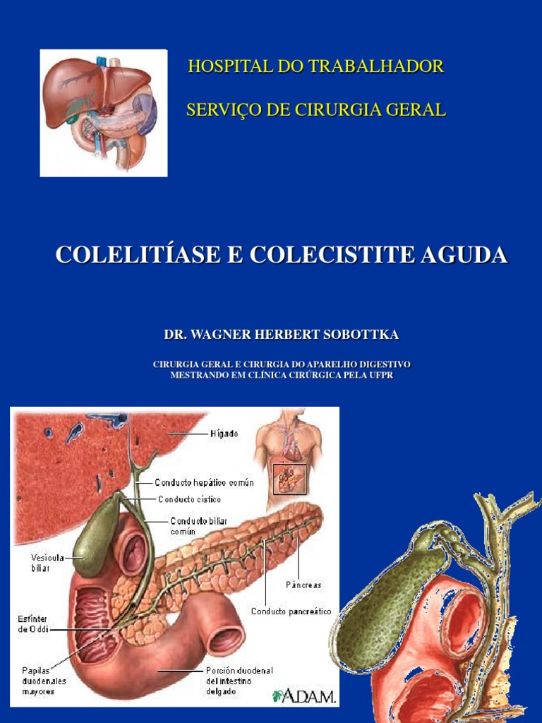 Aula Colelitiase e Colecistite Aguda | PDF | Gastroenterologia | Remédio