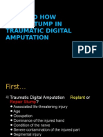 Nerve Stump