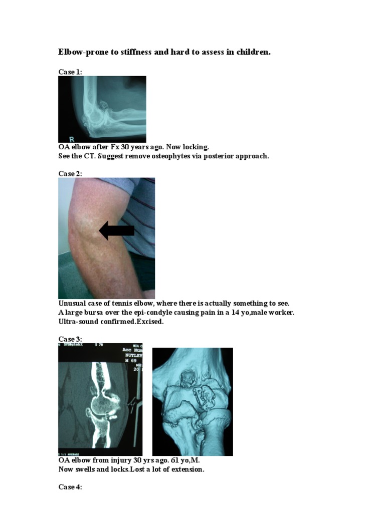 Elbow-Prone To Stiffness | PDF | Science & Mathematics