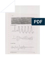 Ecg Aritmia