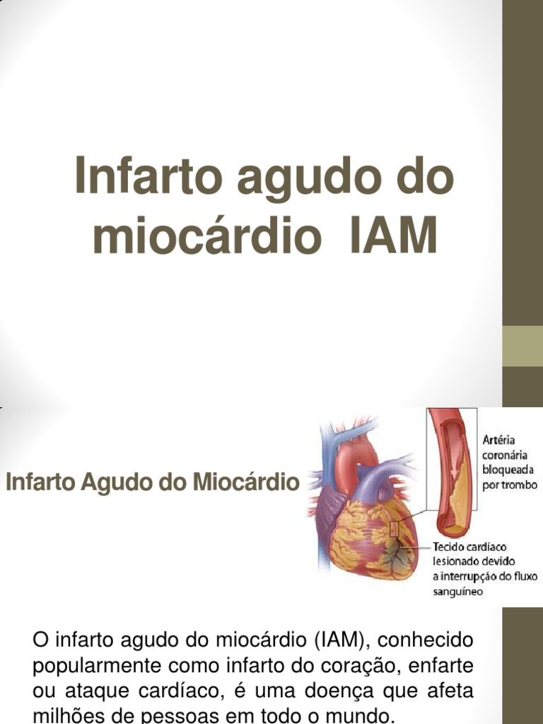 Infarto Agudo do Miocárdio: Sintomas e Tratamento | PDF | Infarto do ...