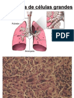 Carcinoma Cels Grandes