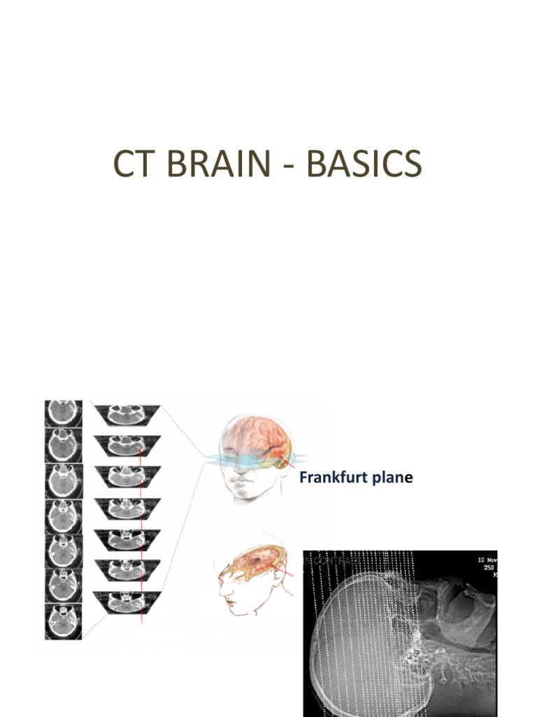CT Brain Imaging Basics and Techniques | PDF | Ischemia | Cerebellum, image size:768x1024