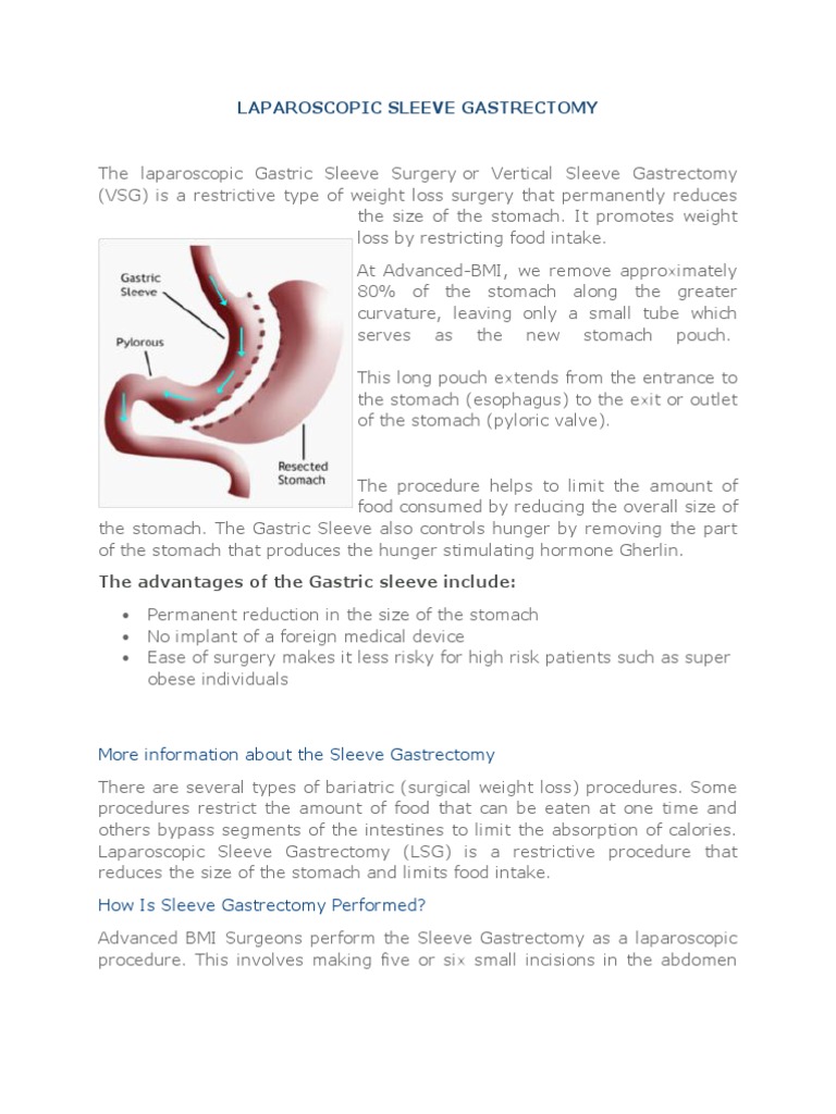 Gastric Sleeve Surgery by Dr Nagi Safa Bariatric Surgery