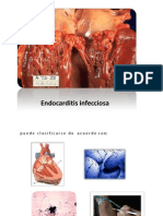 Endocarditis