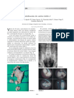 Calcificación de Catéter Doble J