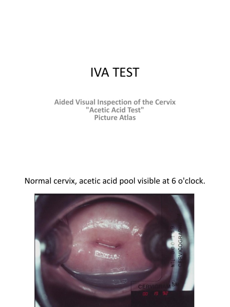 Iva Test PDF