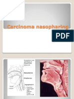 Carcinoma Nasopharinx