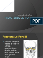 Fractura Le Fort III