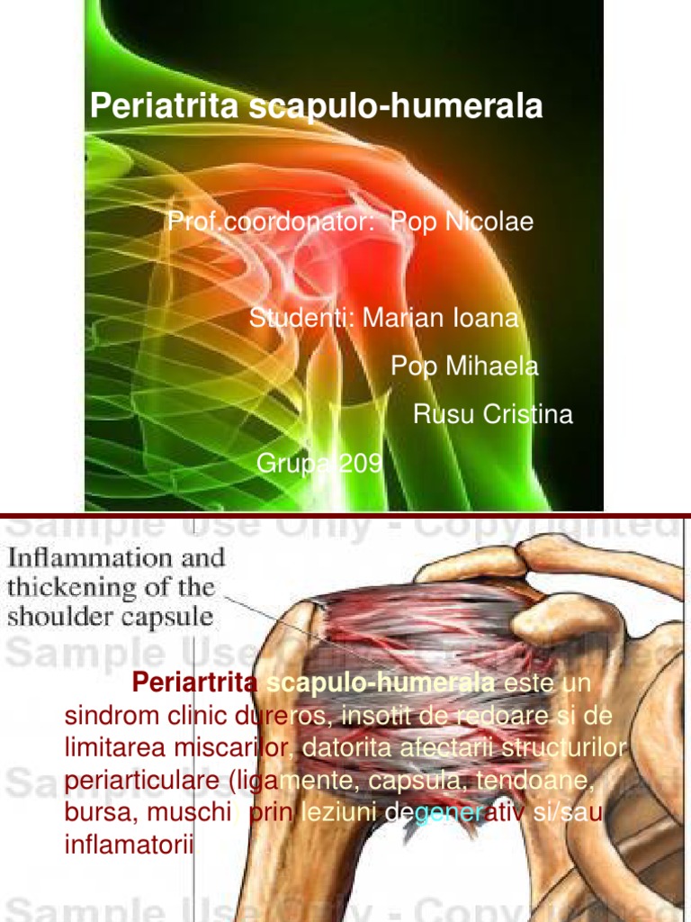 periartrita scapulohumerala referat