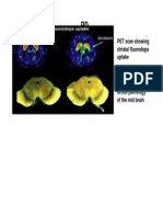 Normal PD: PET Scan Showing Striatal Fluorodopa Uptake