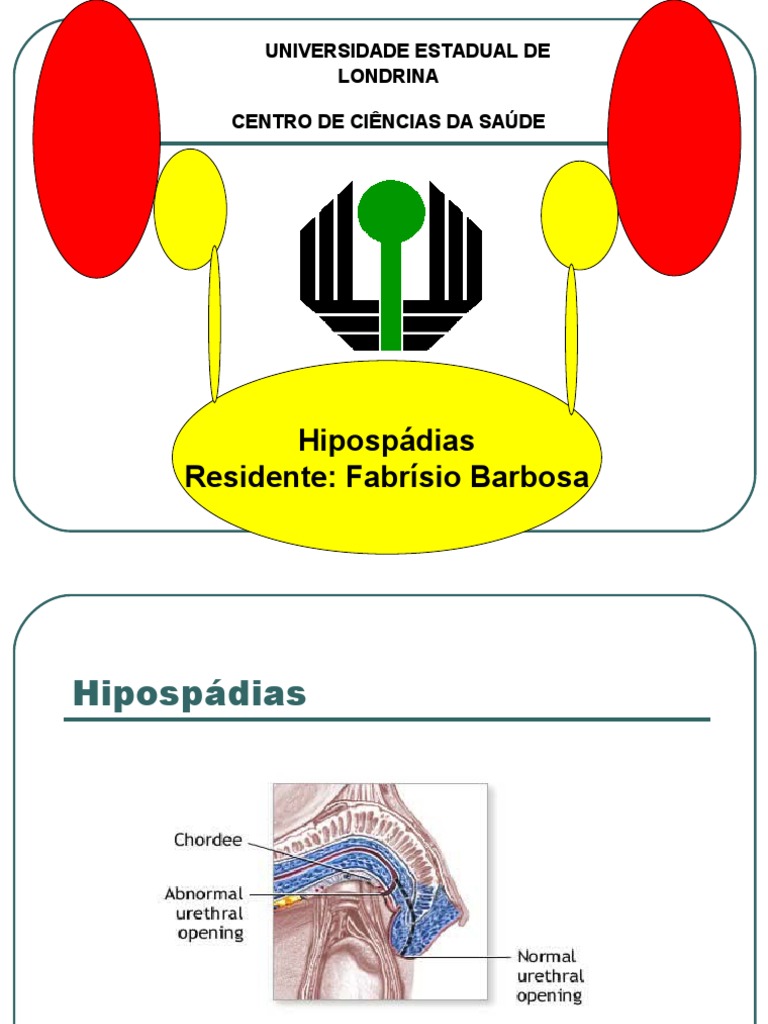 Hipospádias revisão | Pênis | Anatomia Sexual