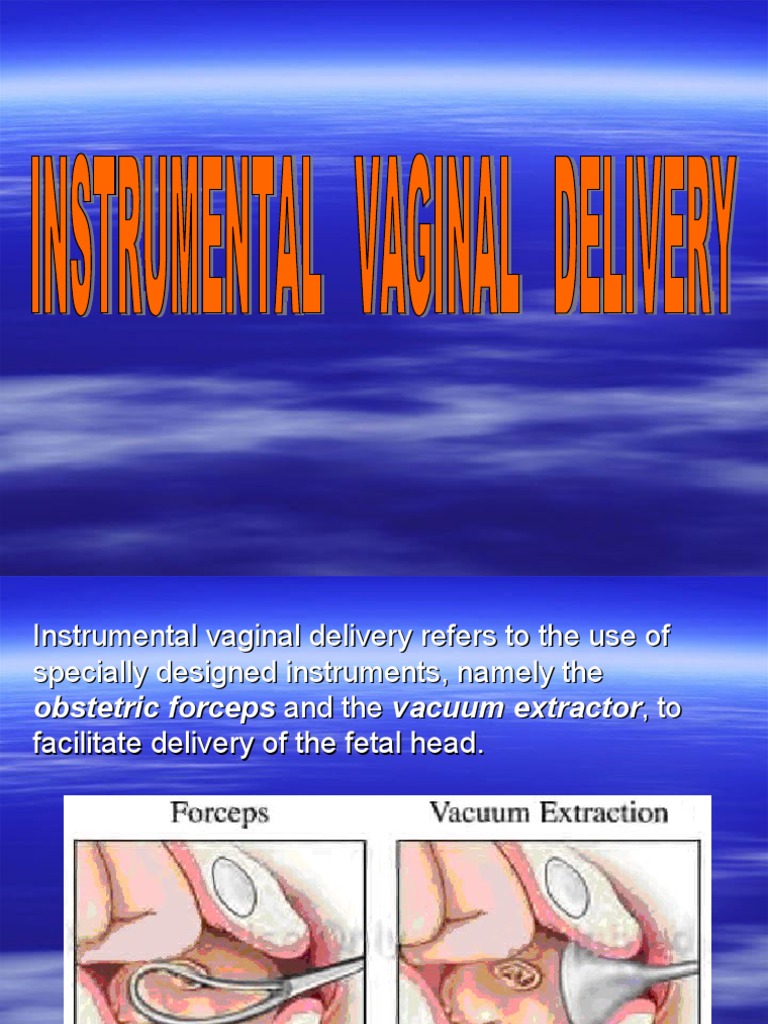 Overview of Instrumental Vaginal Delivery | PDF | Childbirth | Maternal ...