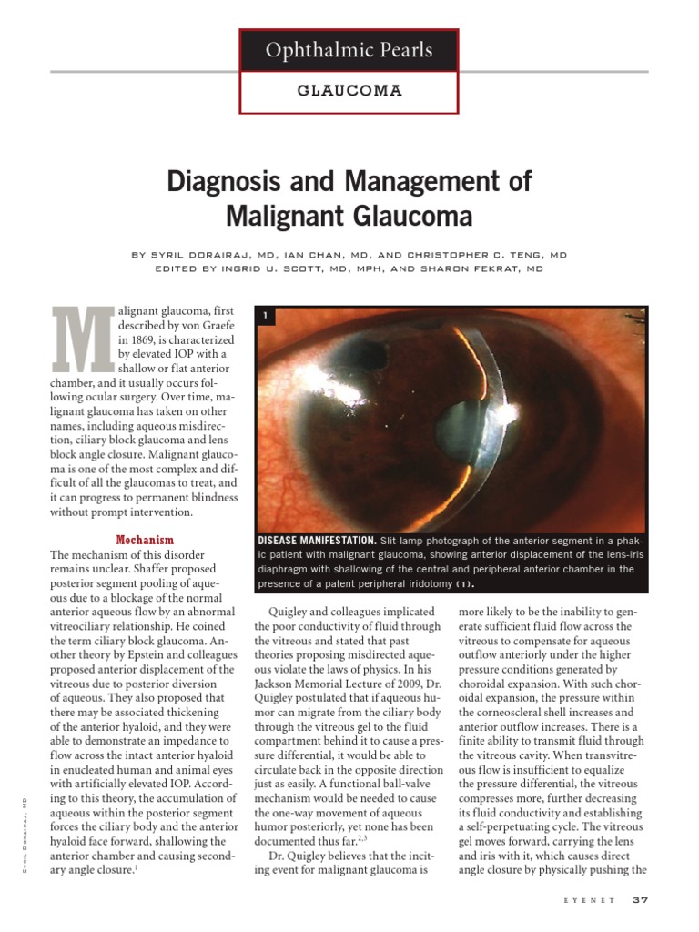 Diagnosis and Management of Malignant Glaucoma | Download Free PDF ...