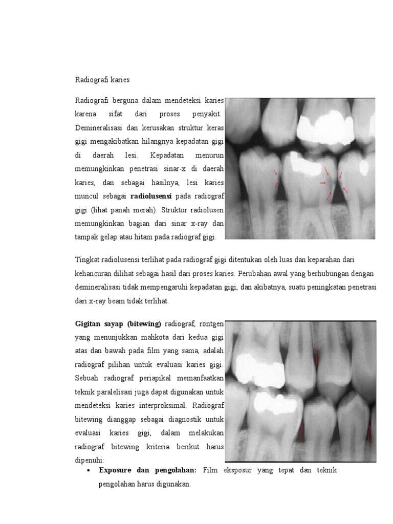 Radiografi karies