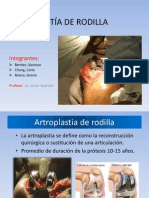 Artroplastía de Rodilla