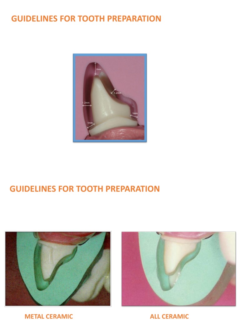 Guidelines For Tooth Preparation | PDF | Home & Garden | Technology ...