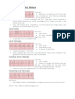 Aritmia EKG