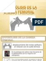 Epifiolisis de Cabeza Femoral Presentacion